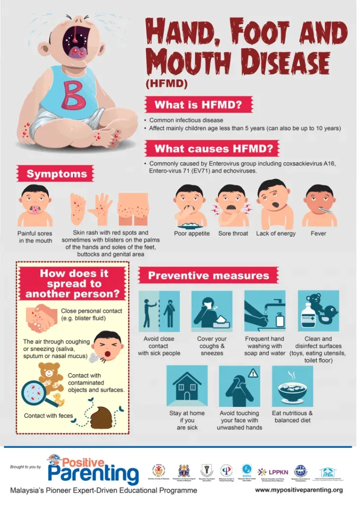 hand foot mouth disease 768x1086 1 724x1024